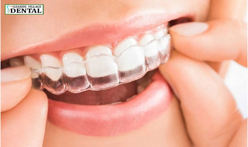 Benefits of Invisalign and Clear Aligners