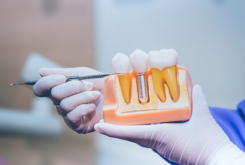 Top 10 Tips for Prolonging the Lifespan of Your Dental Implants