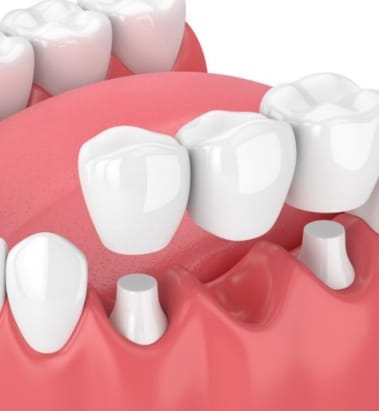 Dental Crowns and Bridges - Dental Services in East York, ON