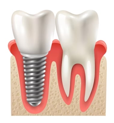 Dental Implants - Dental Services in East York, ON