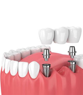 Dental Implants in East York, ON