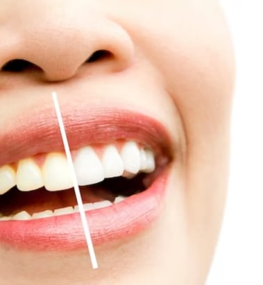 Teeth Whitening - Dental Services in East York, ON