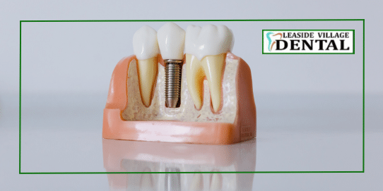 Dental implants